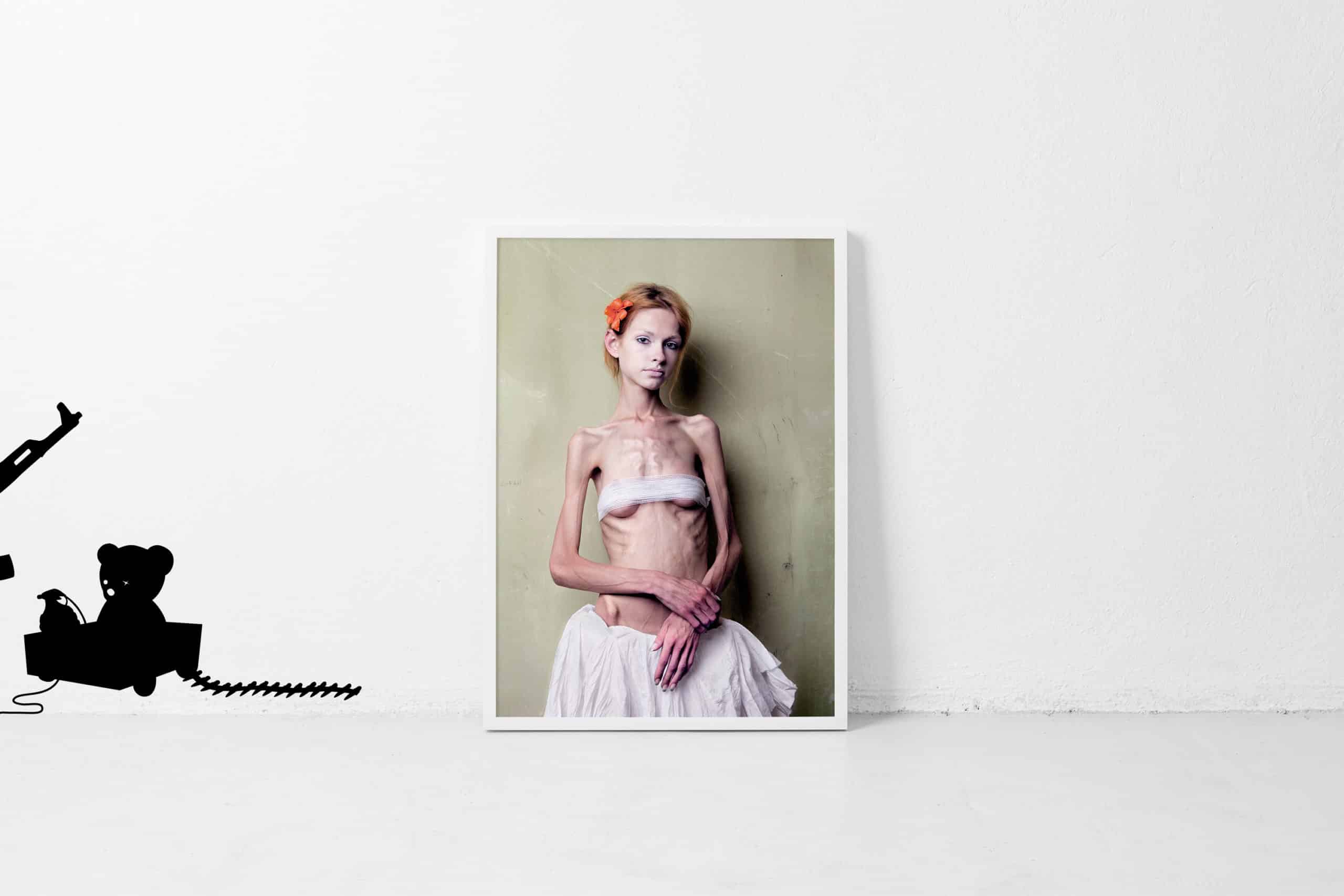 Œuvre d'art exposée sur un mur blanc représentant une jeune femme anorexique avec une fleur dans les cheveux, dans une pose introspective, sur un fond texturé vert.
